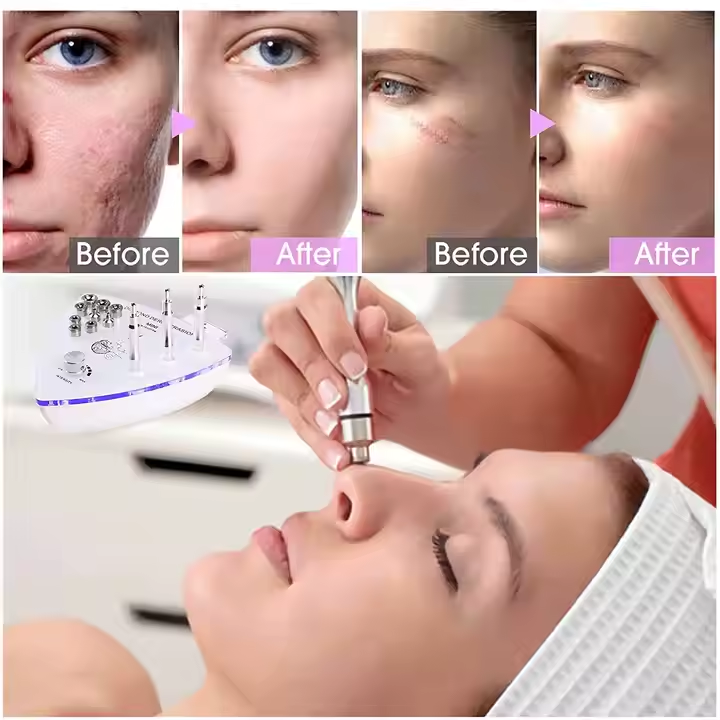 Portable Exfoliation Vacuum Suction Aqua Peel Microdermabrasion Machine Diamond Microdermabrasion Facial Machine