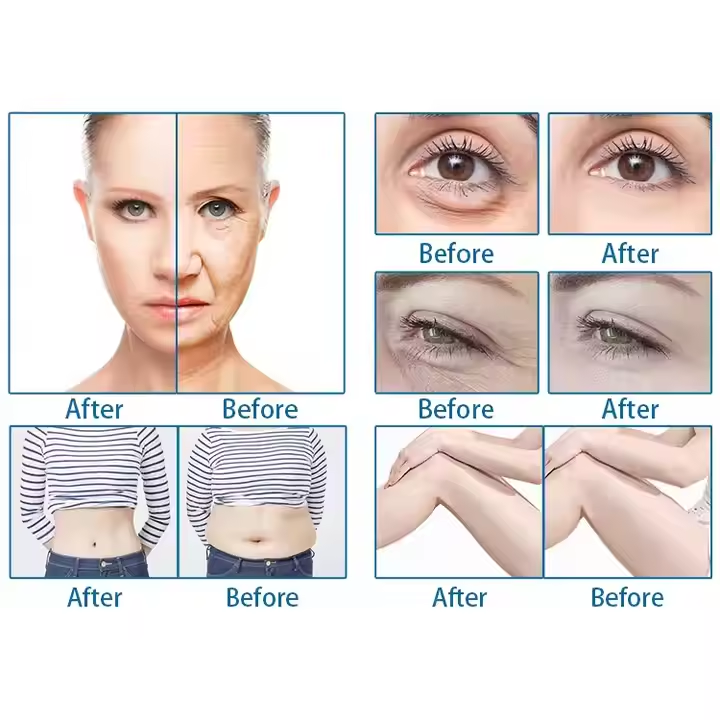 Newest Professional HIfU 9D 7D Skin Tightening Anti-wrinkle Hifu Smas Lifting 9D HIFU Machine