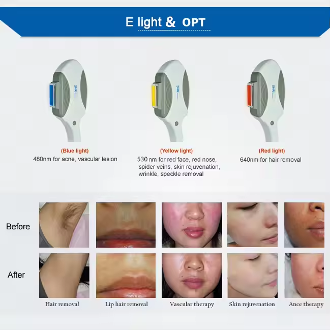 Portable Opt-01 Elight Skin Rejuvenation Therapy Acne Treatment Opt Ipl Shr Fast Hair Removal Laser Machine