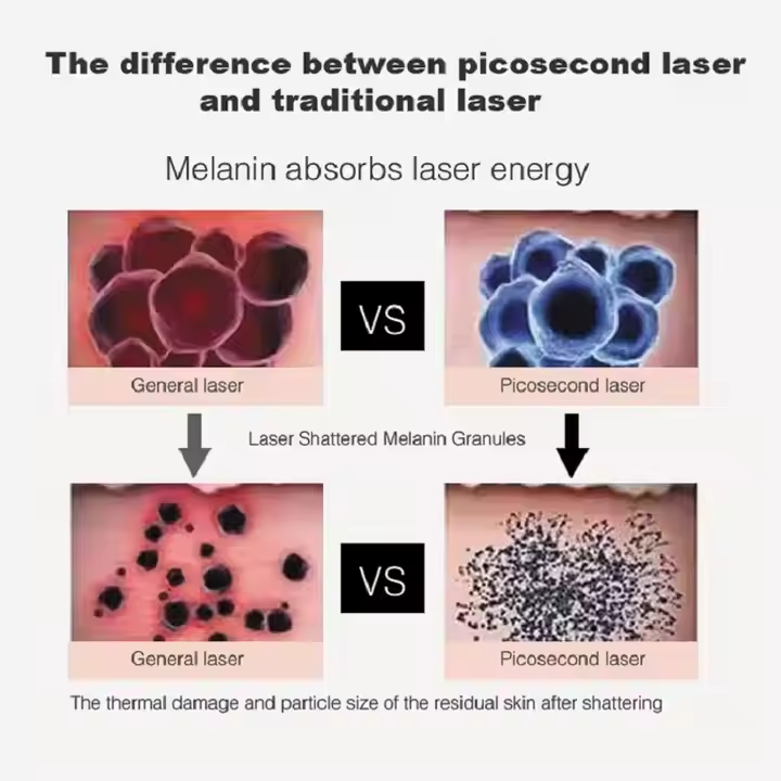 Picosecond Laser Y Tattoo Removal Machine Pico Skin Rejuvenation 755nm 532nm 1064nm Pigment Removal